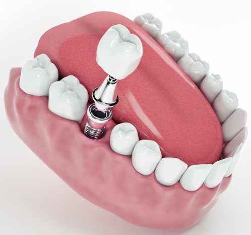 Single Tooth Implants